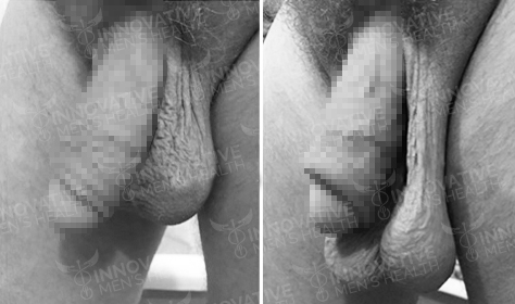 Scrotox Before And After Picture - Innovative Men's Health